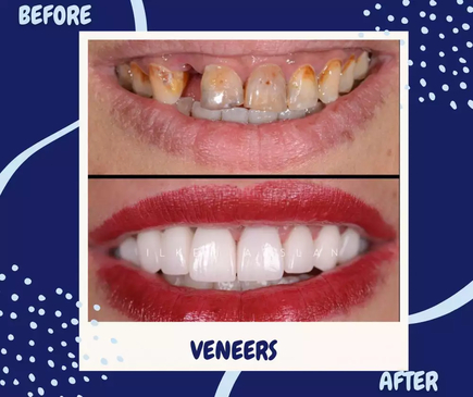 Slider image (4) Universe Dental - Best Dental Clinic in Tbilisi, Georgia
